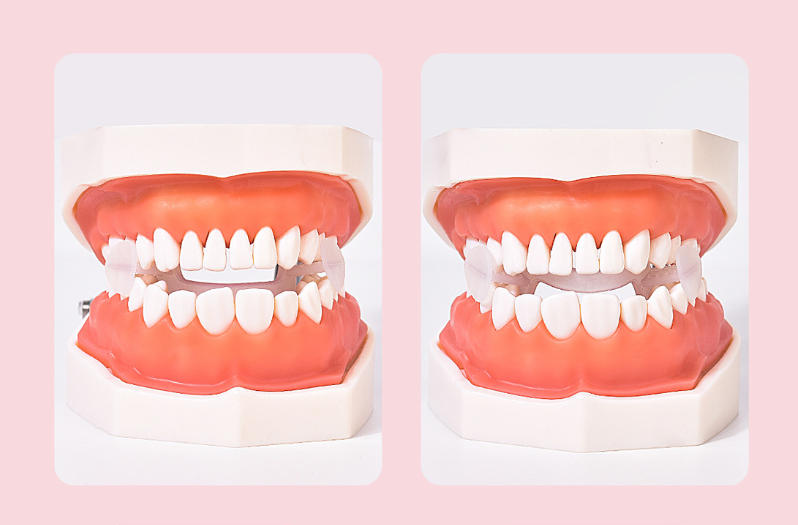 anti-grinding teeth brace